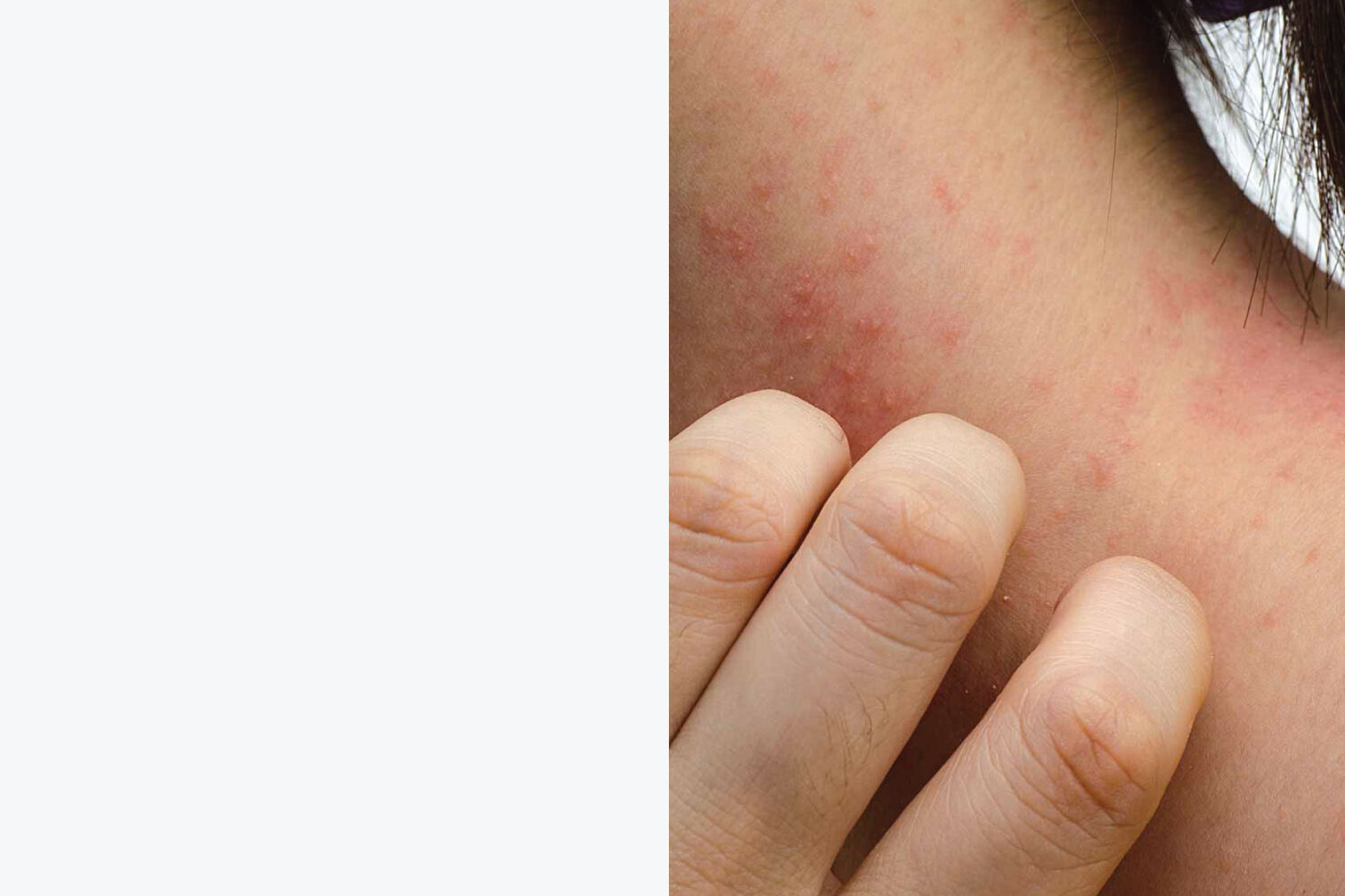Eczema-prone skin