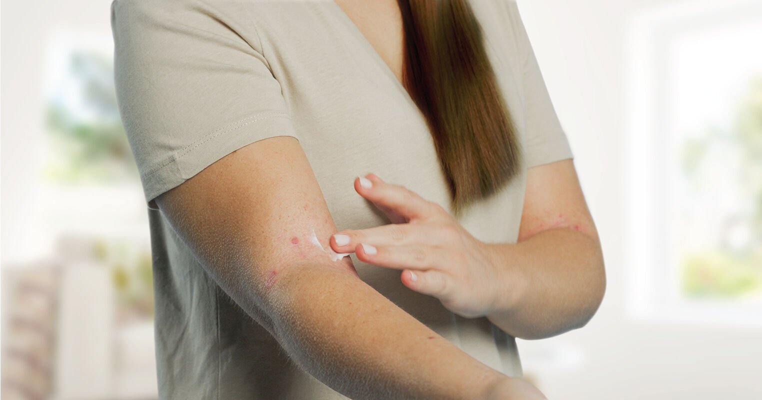 dry-skin-sacondary